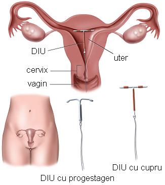 dispozitiv intrauterin - sterilet